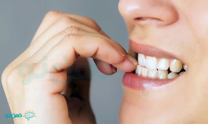 اختلال ناخن جویدن بزرگسالان