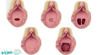 پاره شدن پرده بکارت و راه تشخیص پارگی پرده بکارت