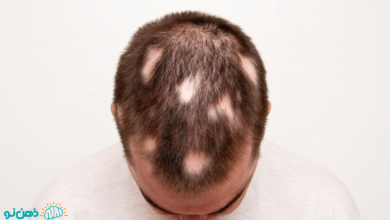 ریزش سکه ای مو چه درمان هایی دارد؟