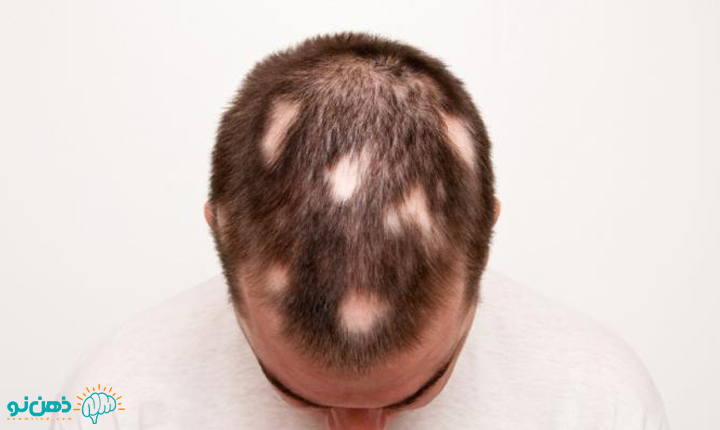 ریزش سکه ای مو چه درمان هایی دارد؟
