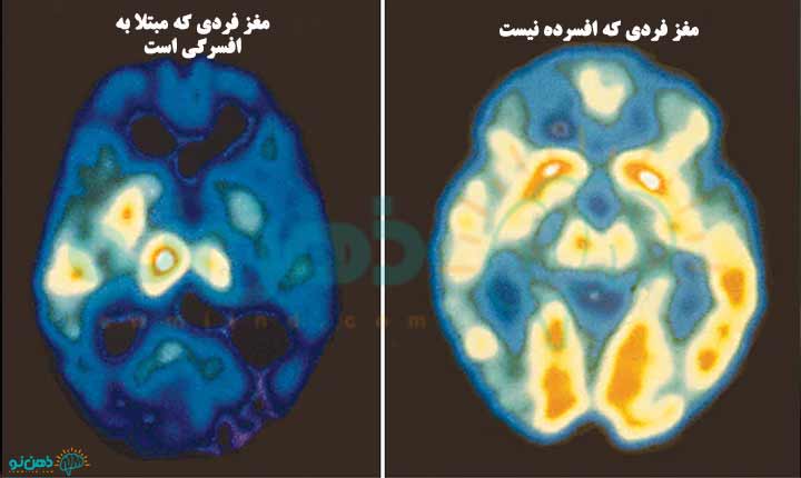 افسردگی و کارکردهای مغز