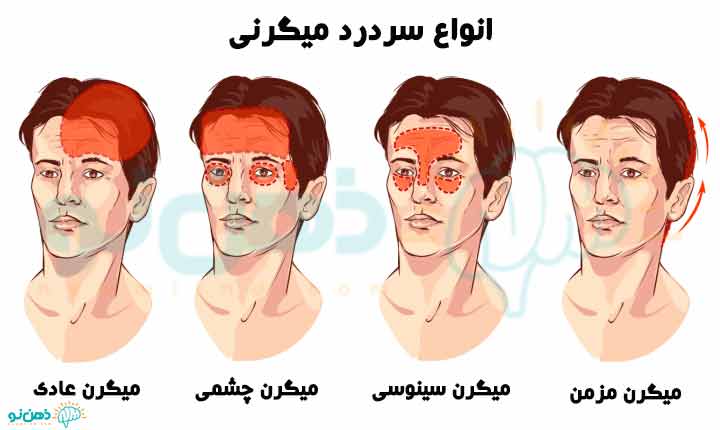 روش های درمان میگرن