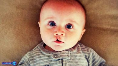 لب شکری بودن نوزاد