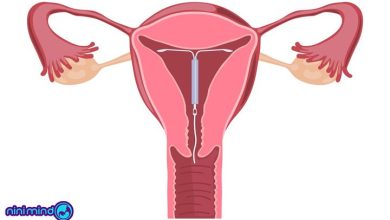آی یو دی (IUD) چیست