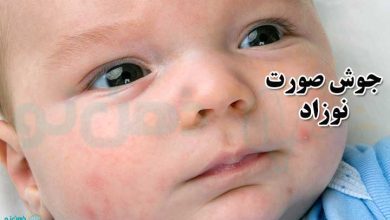 جوش صورت نوزاد