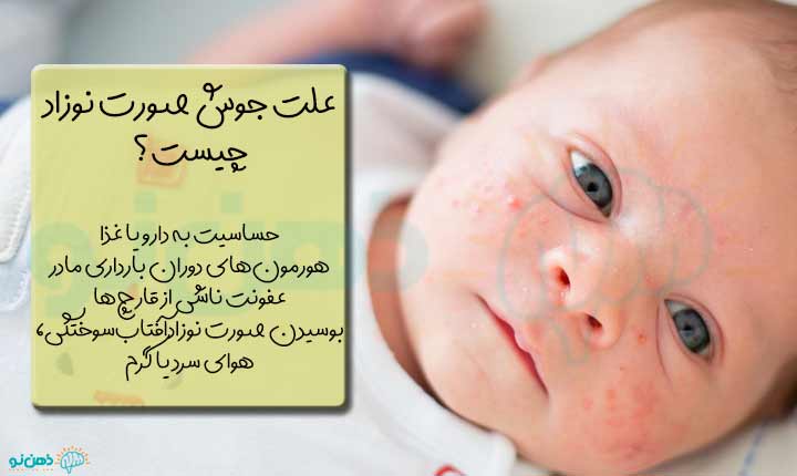 علت جوش صورت نوزاد