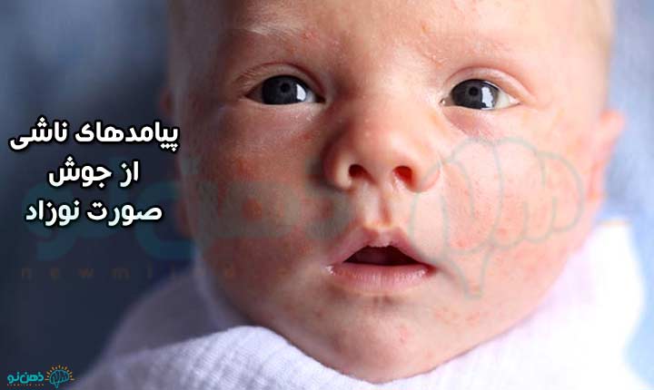 عوارض جوش صورت نوزاد