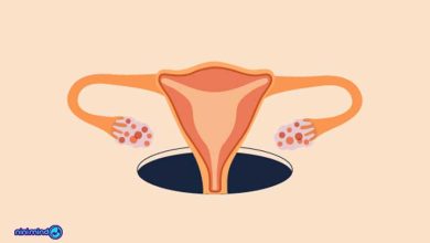 تنبلی تخمدان یا سندروم تخمدان پلی کیستیک