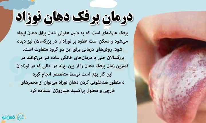درمان برفک دهان نوزاد
