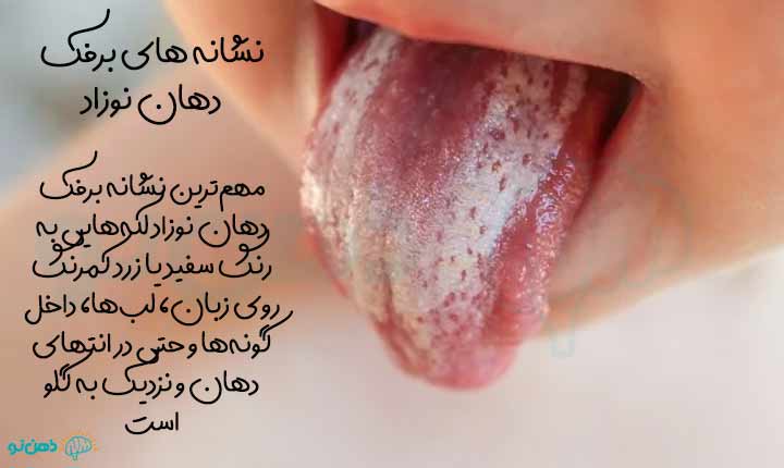 نشانه های برفک دهان نوزاد