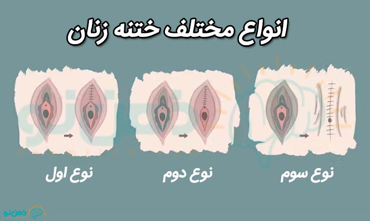انواع ختنه زنان