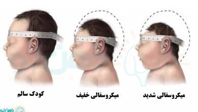 انواع میکروسفالی