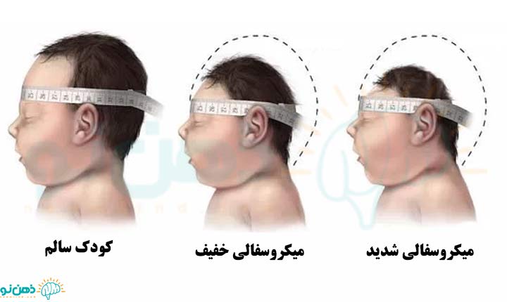 انواع میکروسفالی