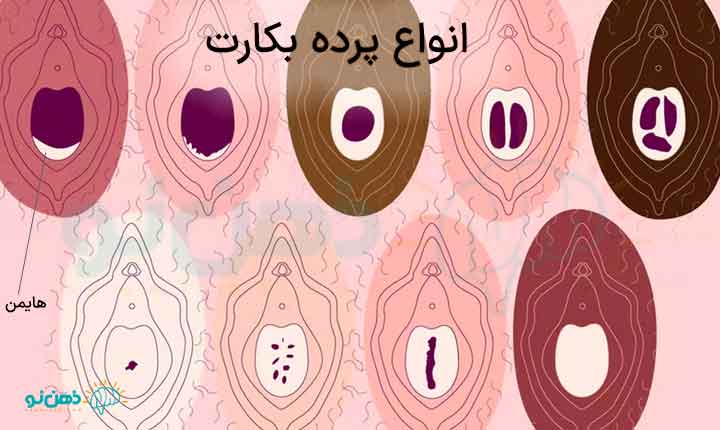 انواع هایمن