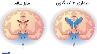 بیماری هانتینگتون