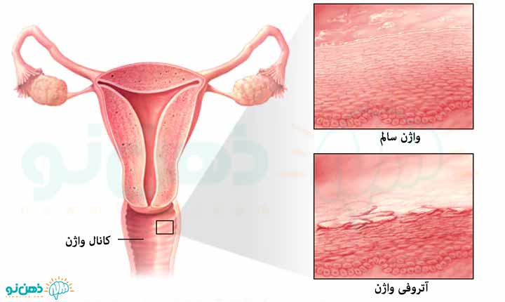 درمان خشکی در واژن