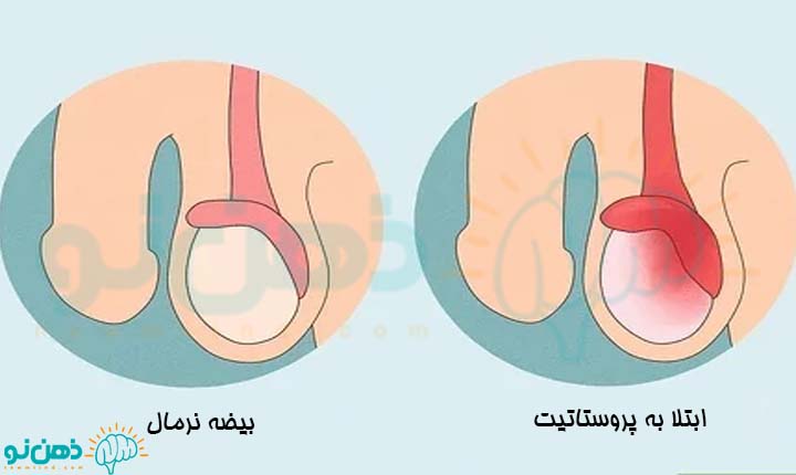 درمان درد بیضه بعد از رابطه
