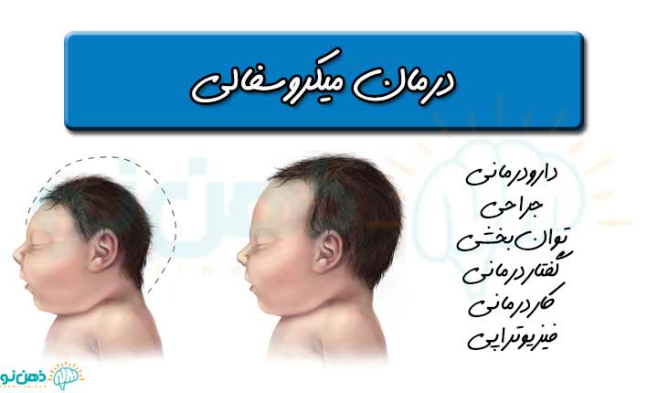 درمان میکروسفالی