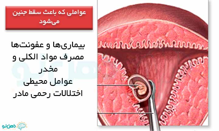 دلایل سقط جنین