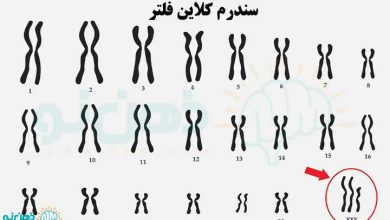 سندرم کلاین فلتر