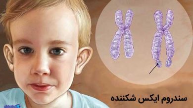 سندروم ایکس شکننده