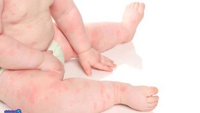 مشکلات پوستی نوزاد