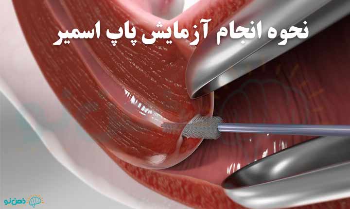 نحوه انجام آزمایش پاپ اسمیر