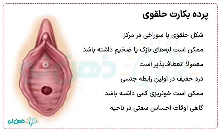 پرده بکارت حلقوی