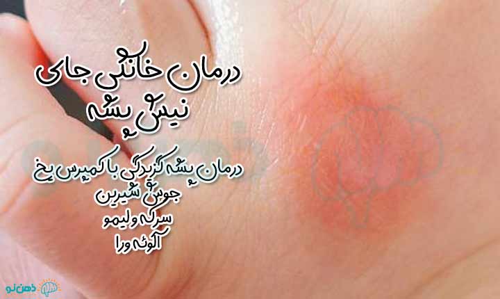 درمان نیش پشه در کودکان