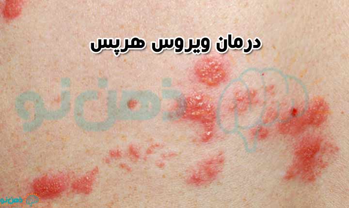 درمان ویروس هرپس