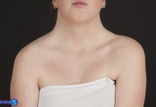 سندرم ترنر درمان دارد