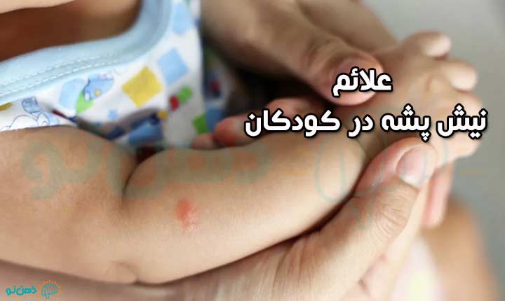 علائم نیش پشه در کودکان