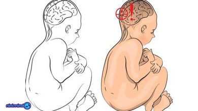 فلج مغزی نوزاد