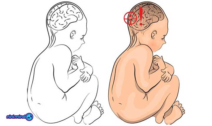 فلج مغزی نوزاد