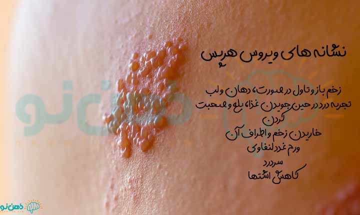 نشانه های ویروس هرپس