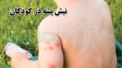 نیش پشه در کودکان