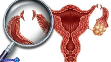 بستن لوله رحم زنان