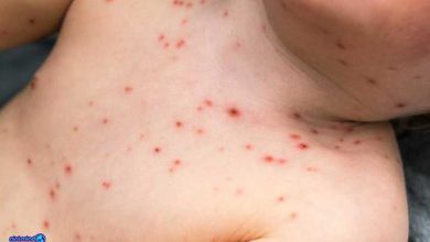 بیماری سرخجه