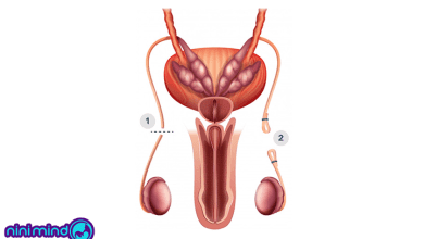 وازکتومی قابل برگشت است