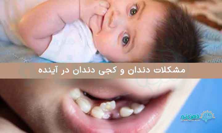 عوارض مکیدن انگشت در کودک