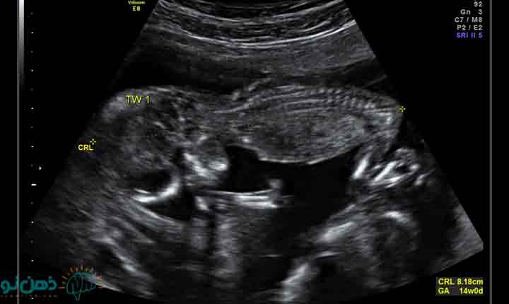 عوارض شایع مادر در هفته چهاردهم بارداری