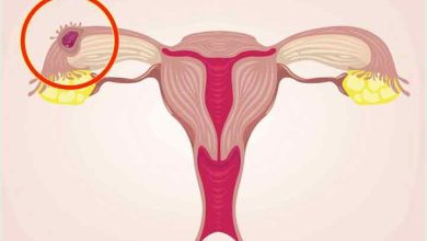 بارداری خارج از رحم