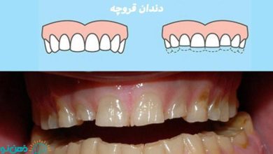 دندان قروچه در بزرگسالان