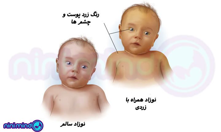 نشانه-های-زردی-نوزاد،-نینی-مایند