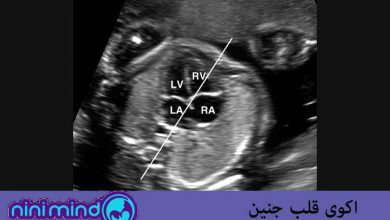 اکو-قلب-جنین