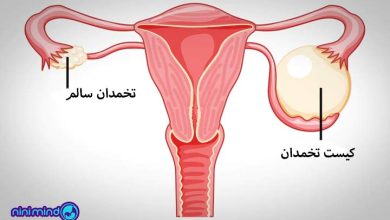 کیست تخمدان