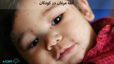 آبله مرغان در کودکان