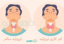 کم کاری تیروئید