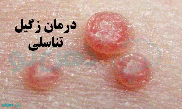 درمان زگیل تناسلی