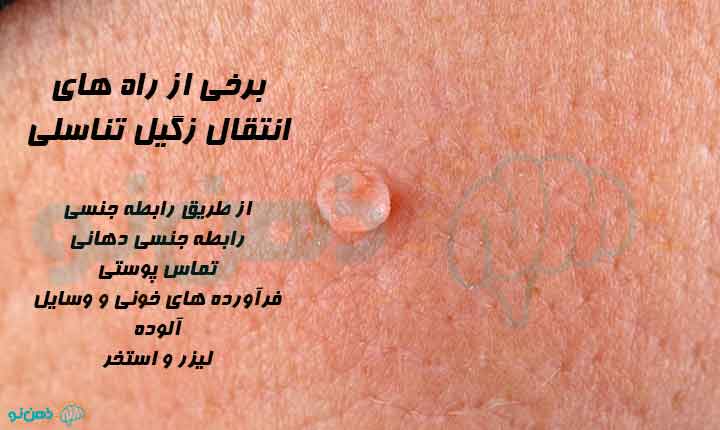 راه های انتقال زگیل تناسلی